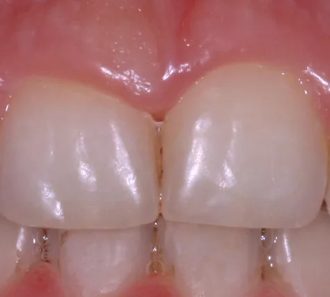 Gingivektomie vorher, DDr. Baudisch, Regau